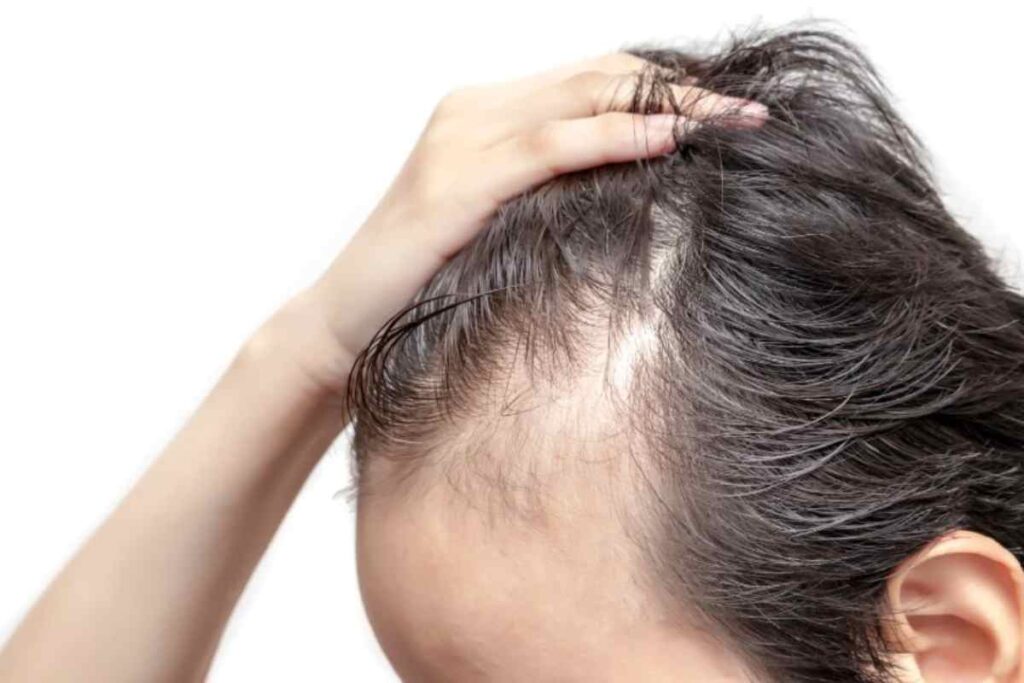 Problemi capelli, tiroide