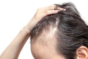 Problemi capelli, tiroide