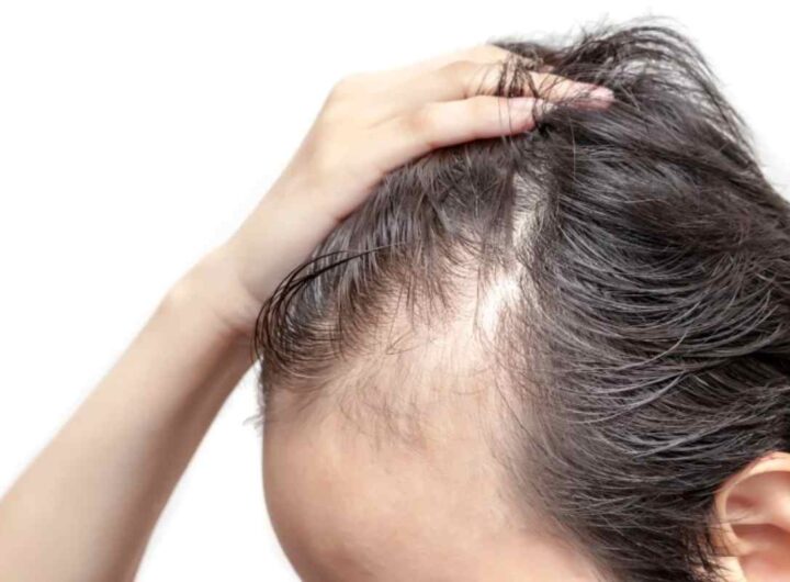 Problemi capelli, tiroide